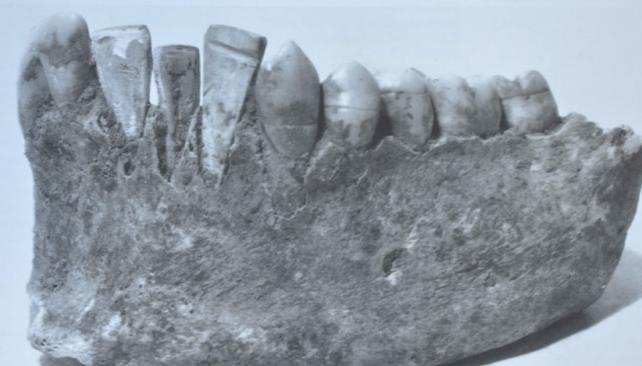 Breve historia de los implantes dentales
